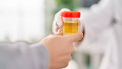 اختبار تحليل البول.. ثورة في الكشف المبكر عن السرطان